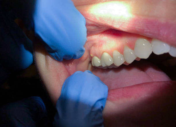 Best Emergency Dental Care for Sports Injuries in Easton, PA